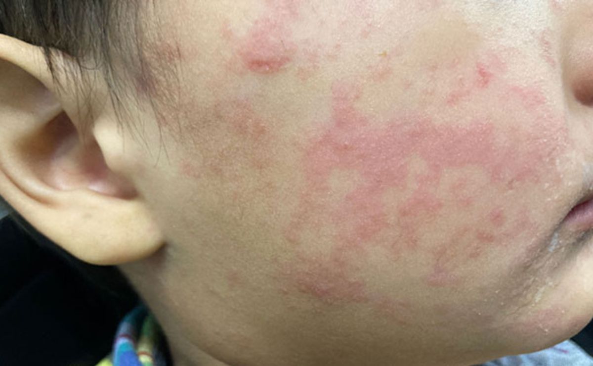 Suman 32 fallecimientos por sarampión