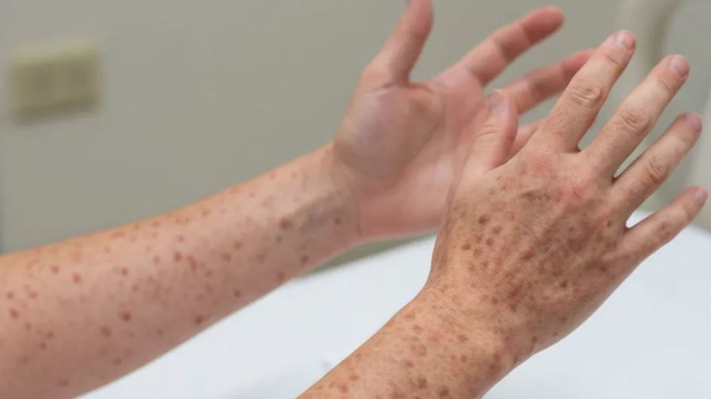 Prohíben visitas a centro de detención de migrantes en Texas por brote de sarampión